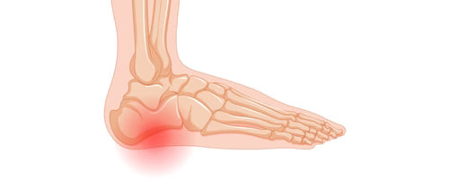 Plantar Fasciitis