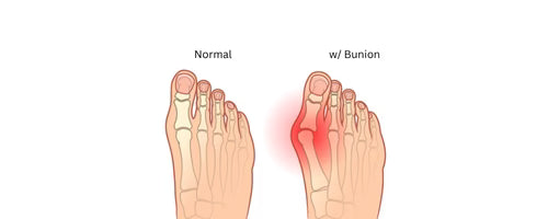 Bunions