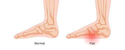 Flat feet