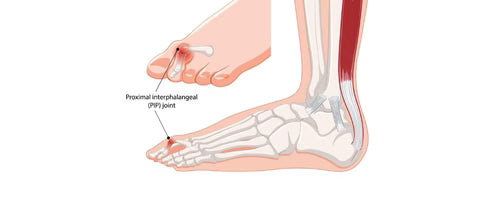 Hammertoes