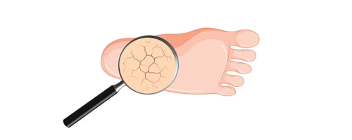 Calluses